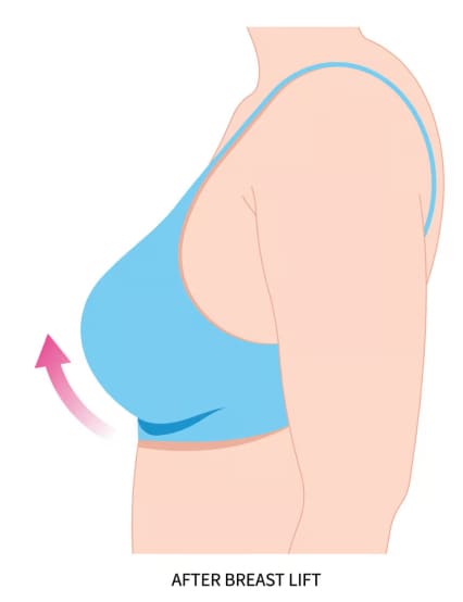 https://phoenixcosmeticcentre.com/public/breast-lift